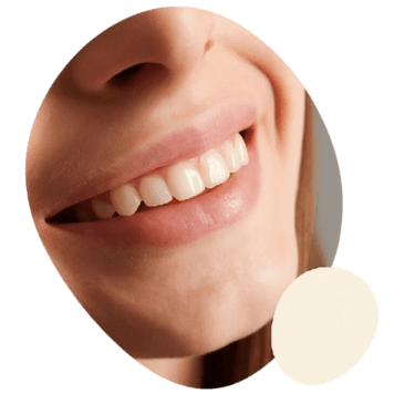 advantage of composite veneers