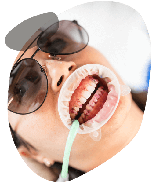 mouthguards at sleek teeth whitening